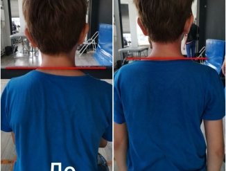 Результат сразу после процедуры