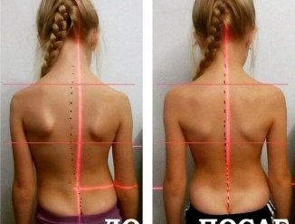 Результат сразу после процедуры