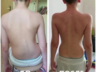 Результат сразу после процедуры